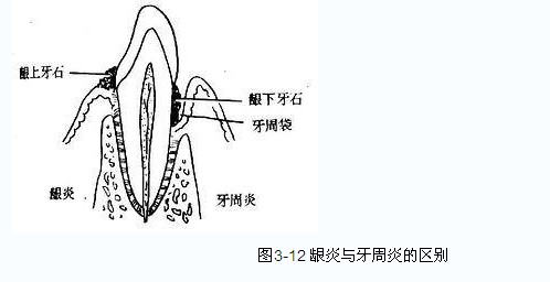 牙周炎症狀
