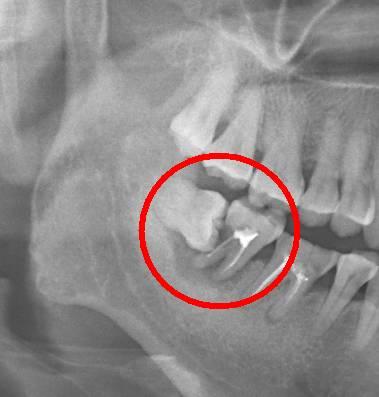 智齒是拔還是留