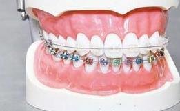 哨牙怎麽(me) 矯正