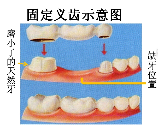 烤瓷牙圖片