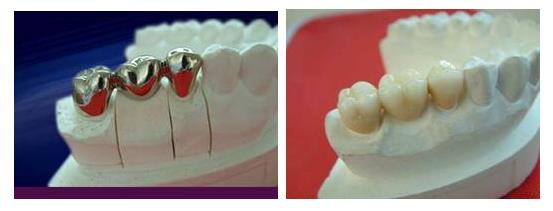 修複牙齒缺損的費用