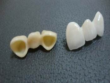 牙齒固定橋修複的價(jia) 格