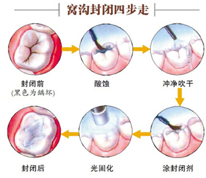 牙齒窩溝封閉多久做