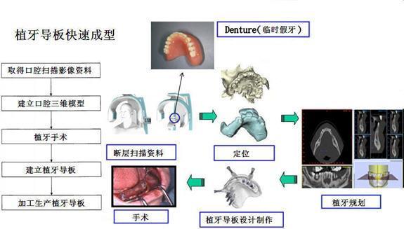 如何種植牙齒