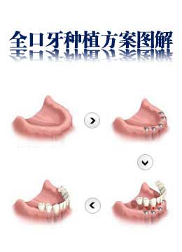 全部牙齒缺失了要補嗎