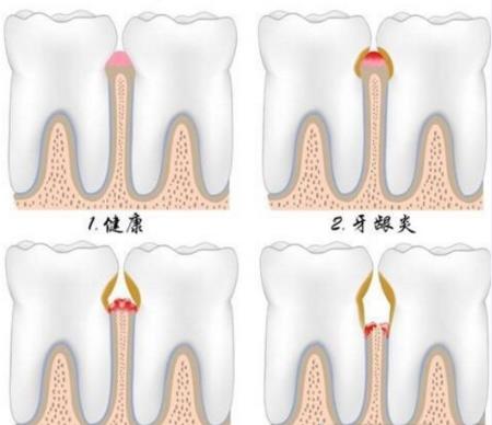 牙周病掉牙可以治療嗎