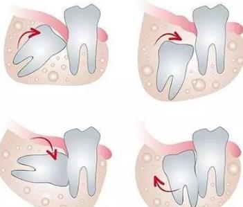 拔智齒**有什麽(me) 注意事項
