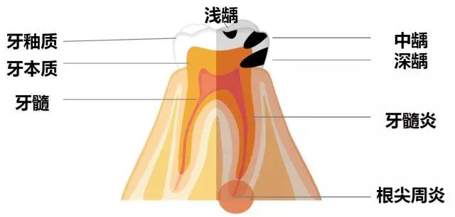 牙髓炎、根尖周炎