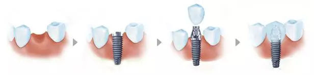 種植牙怎麽(me) 做