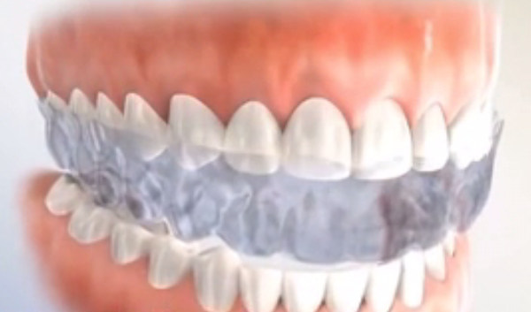 牙齒保持器哪種好