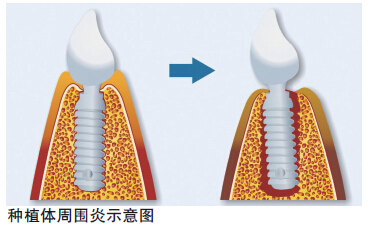 種植牙後出現腫脹