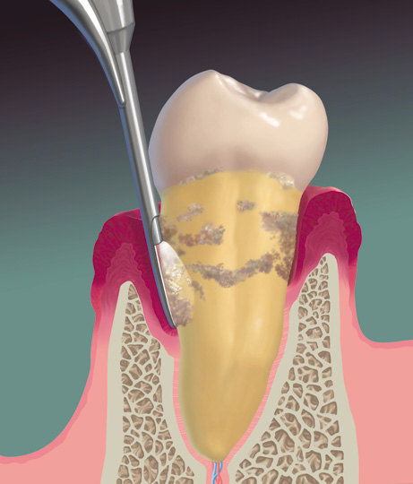 齦下刮治術注意事項
