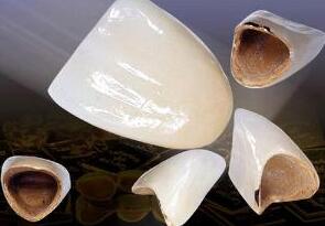 快速牙齒矯正的價(jia) 格