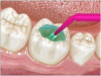 窩溝封閉可以預防蛀牙嗎