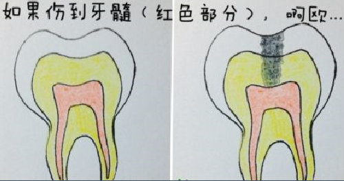  蛀牙什麽(me) 程度要根管治療