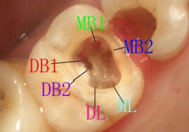 根管治療為(wei) 什麽(me) 那麽(me) 貴