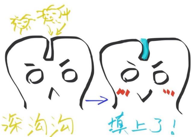 成年人需要做窩溝封閉嗎