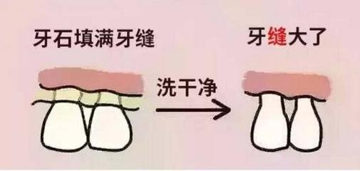 幾個(ge) 關(guan) 於(yu) 洗牙的問題解答