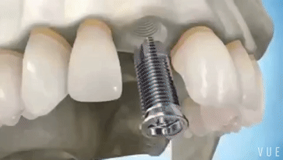 種植牙要花多少錢