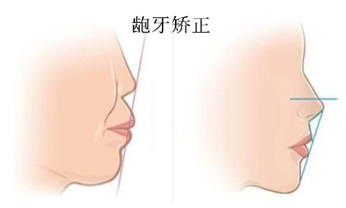 齙牙矯正