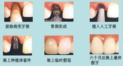 種植義(yi) 齒與(yu) 傳(chuan) 統修複方法的區別