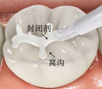 孩子幾歲做窩溝封閉好
