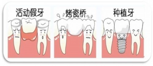 鑲牙齒哪種材料較好