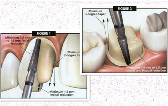做完烤瓷牙後疼痛