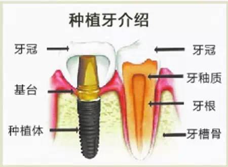 種植牙牙冠多少錢一顆