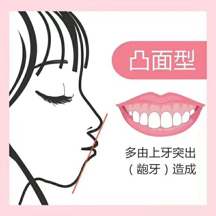 牙齒前突鋼牙矯正要多少錢