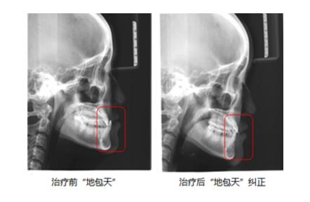 牙齒矯正拍X光片的意義(yi) 