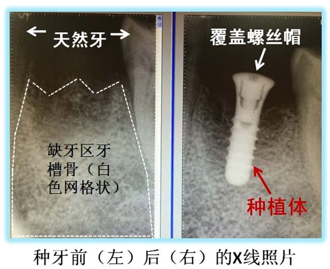 種植牙影響核磁檢查嗎