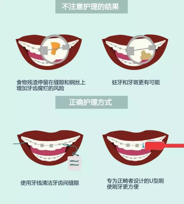 牙齒矯正期間清潔