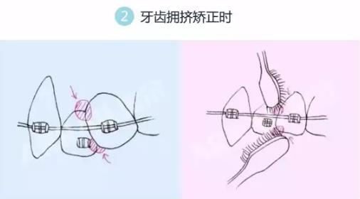 牙齒矯正期間清潔很麻煩怎麽(me) 辦