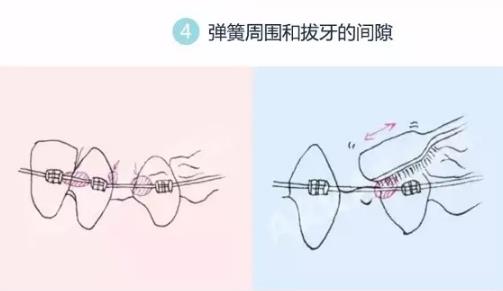 牙齒矯正清潔