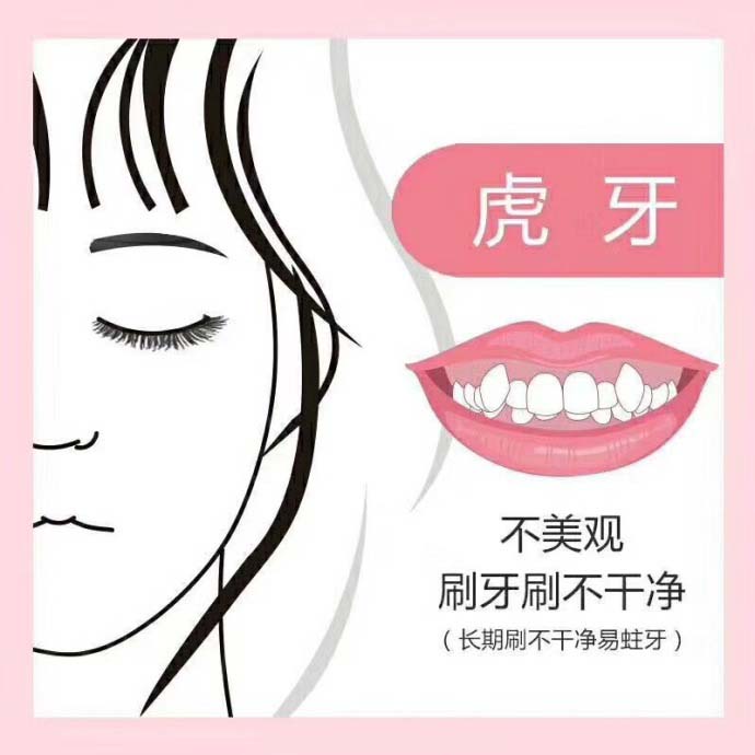 鋼絲(si) 矯正虎牙多少錢