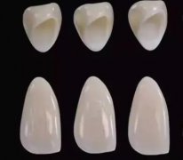 美容冠一顆牙多少錢