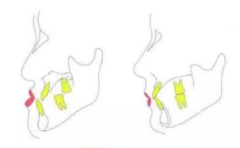 骨性齙牙手術