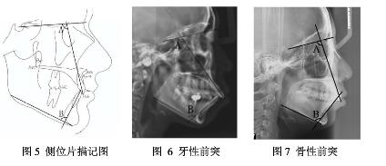 牙槽骨突出手術怎麽(me) 治療