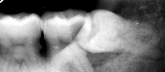 深圳智齒拔牙價(jia) 格