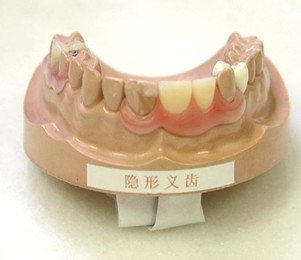 牙齒缺失後做隱形義(yi) 齒