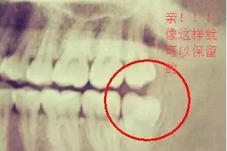 智齒沒有對咬牙