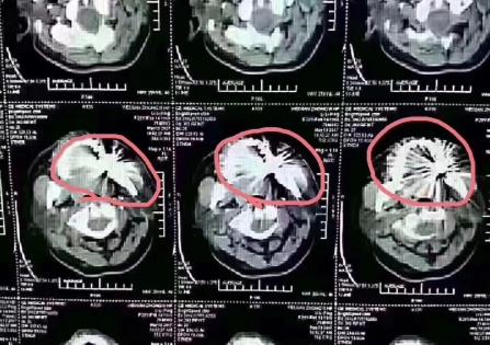 金屬烤瓷牙做核磁共振