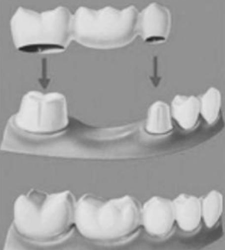 烤瓷牙的利與(yu) 弊