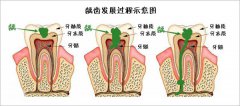 補牙費用是多少