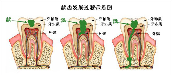 補牙費用是多少
