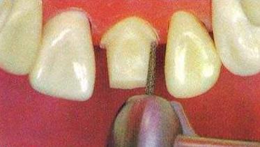 烤瓷牙冠是終身的嗎