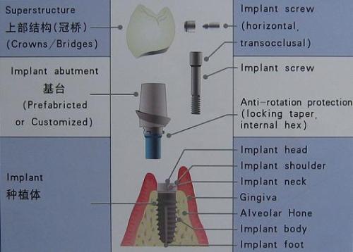 廣州種植一顆牙多少錢