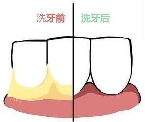 深圳口腔醫院洗牙齒要花多少錢