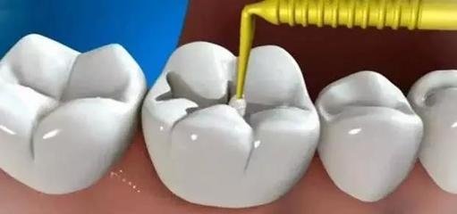 光固化樹脂補牙